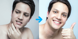 How to remove scar Naturally How to remove scar Naturally