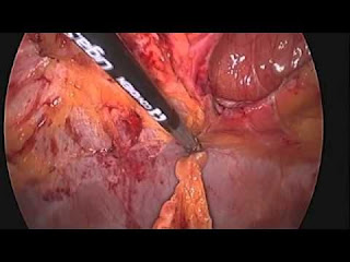 Epigastric Hernia: Causes, Symptoms, and Treatment Epigastric Hernia: Causes, Symptoms, and Treatment